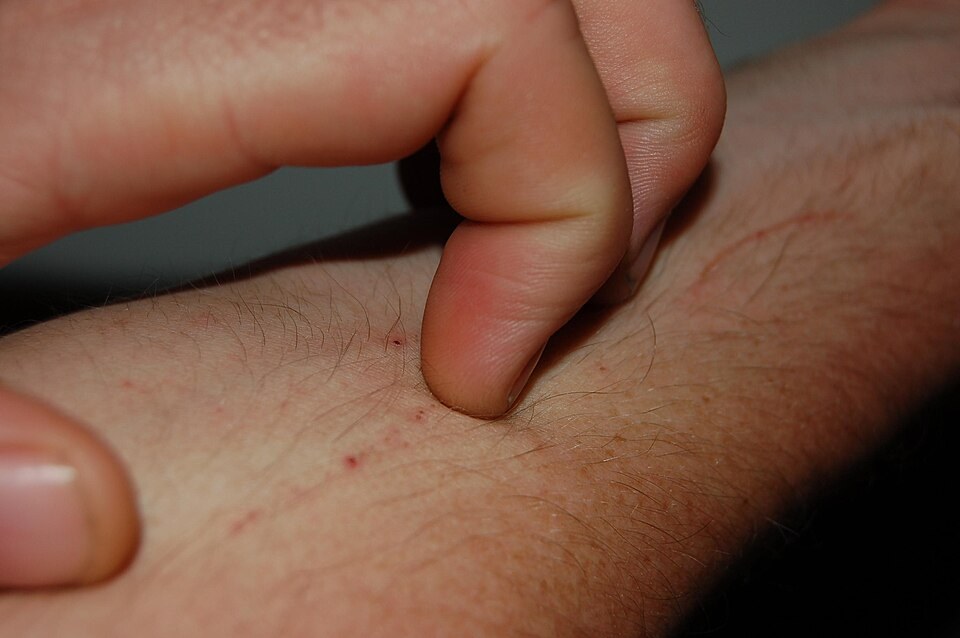 A person scratching an itchy arm