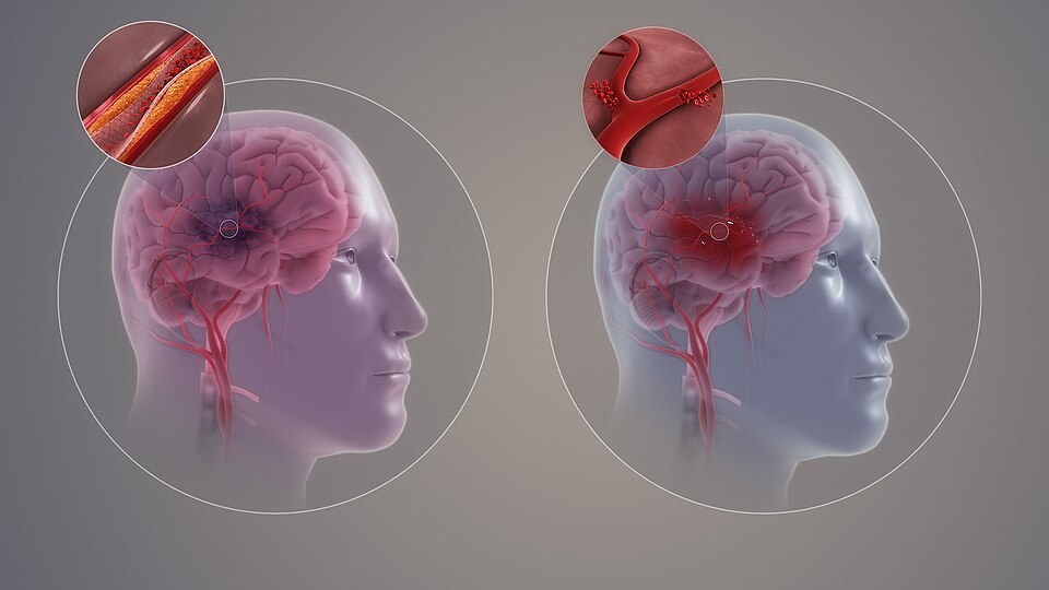 Illustration of a stroke caused by a blocked blood vessel in the brain