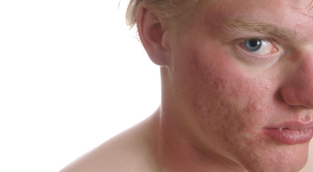 home remedies for acne scars