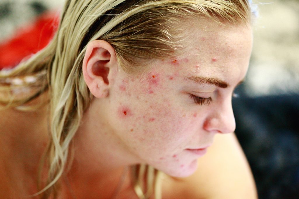 Remove Pimple Scars