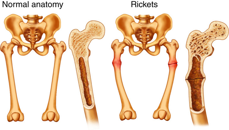 Rickets in children