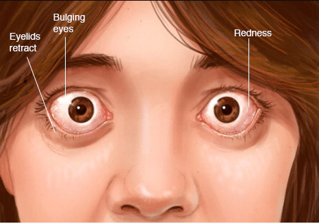 Graves Eye Disease