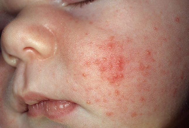 baby acne