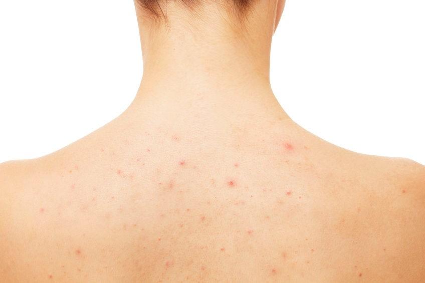 How to get rid of back acne