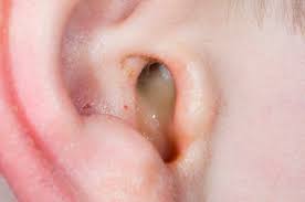 types of ear discharge
