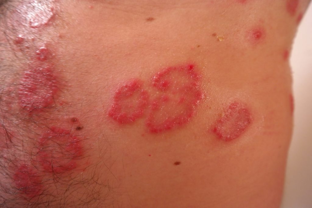 rashes on face
