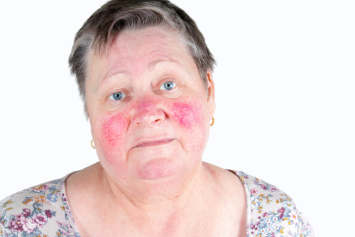 Ruddy Complexion