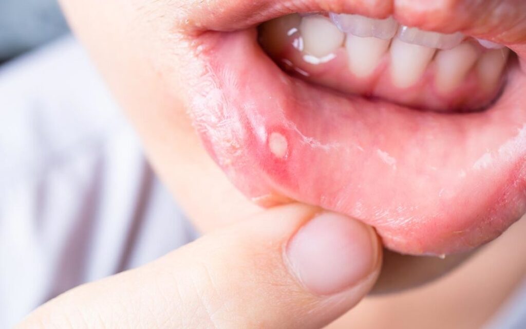 get rid of cold sore