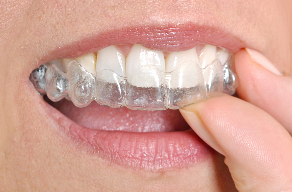 invisalign braces