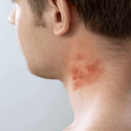 Inverse Psoriasis