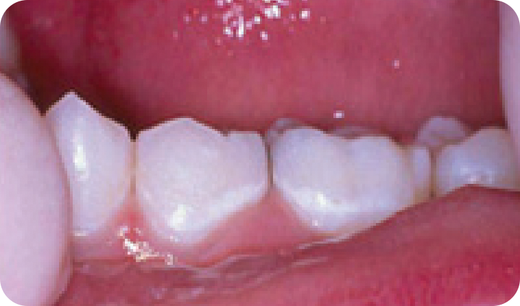 White Spots On Teeth