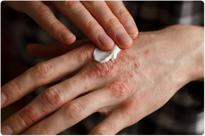Eczema treatment