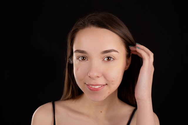 kratom for pimples - featured image