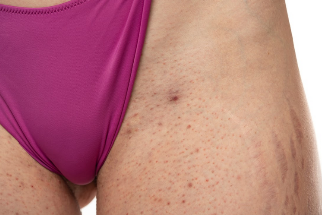 genital bumps